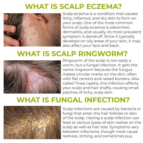 Folliculitis Shampoo - Antifungal Treatment for Seborrheic Dermatitis & Dandruff | Soothes Itchy Scalp