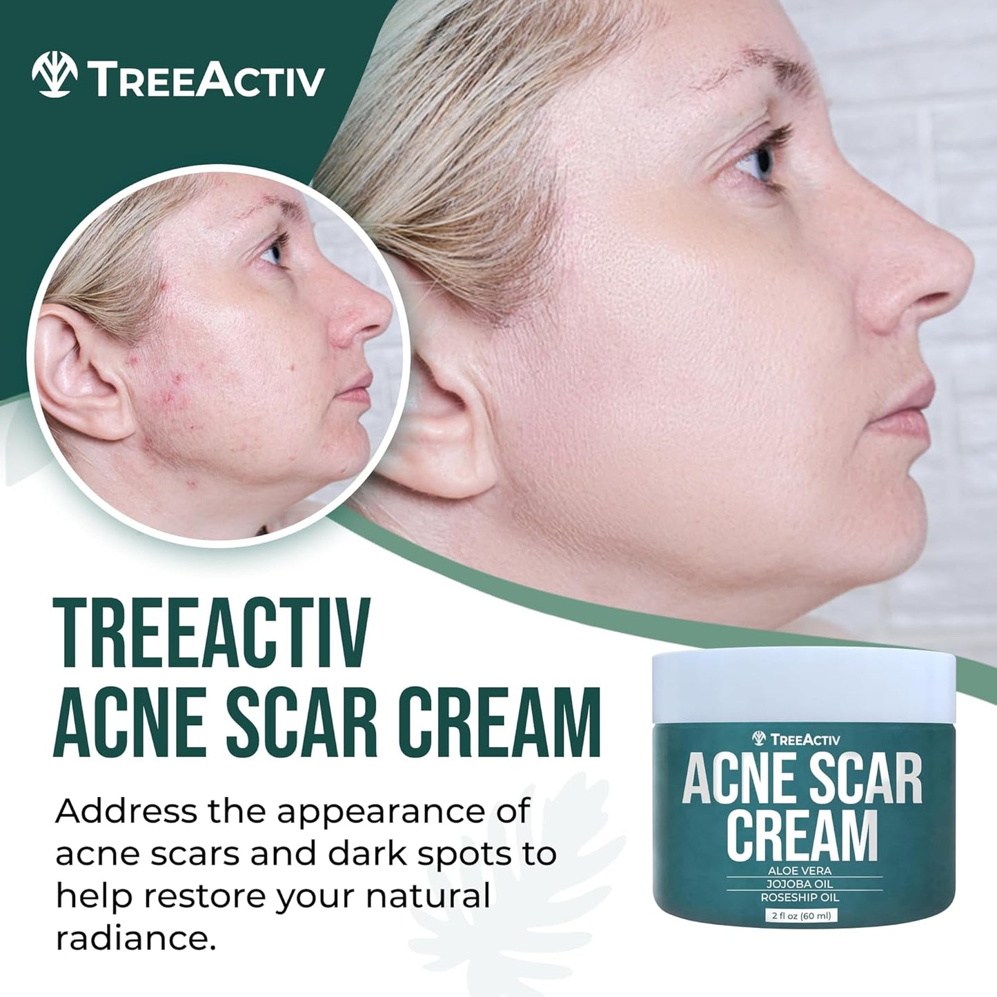 TreeActiv Acne Scar Cream - Dark Spot Remover & Stretch Mark Lotion | 2 fl oz for All Skin Types