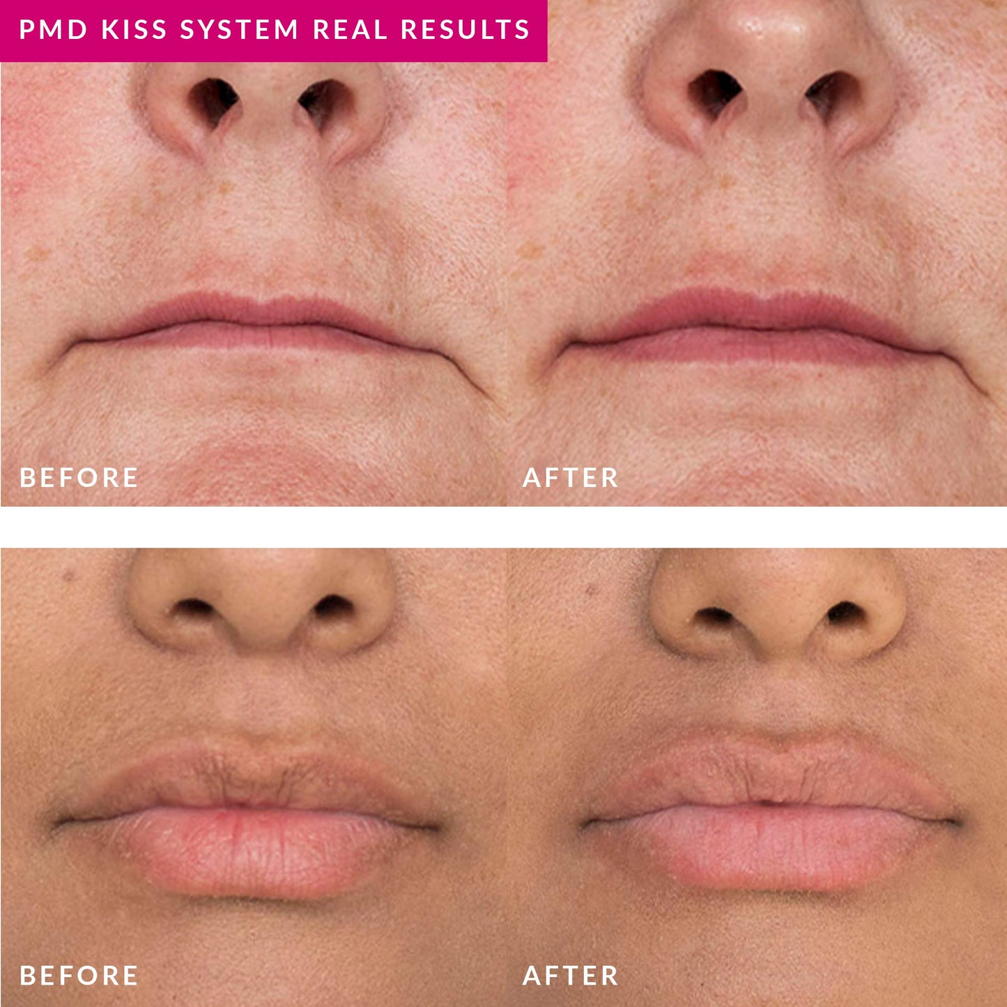 PMD Smart Lip Plumping Serum, 10 ml