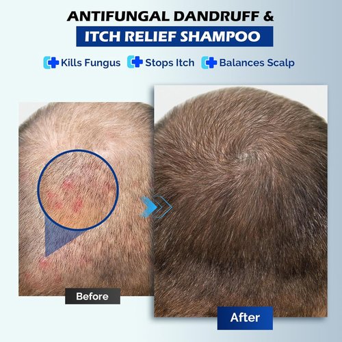 Regine Switzerland Antifungal Psoriasis Shampoo - Relieves Scalp Itching & Dryness | 10.1 Fl Oz