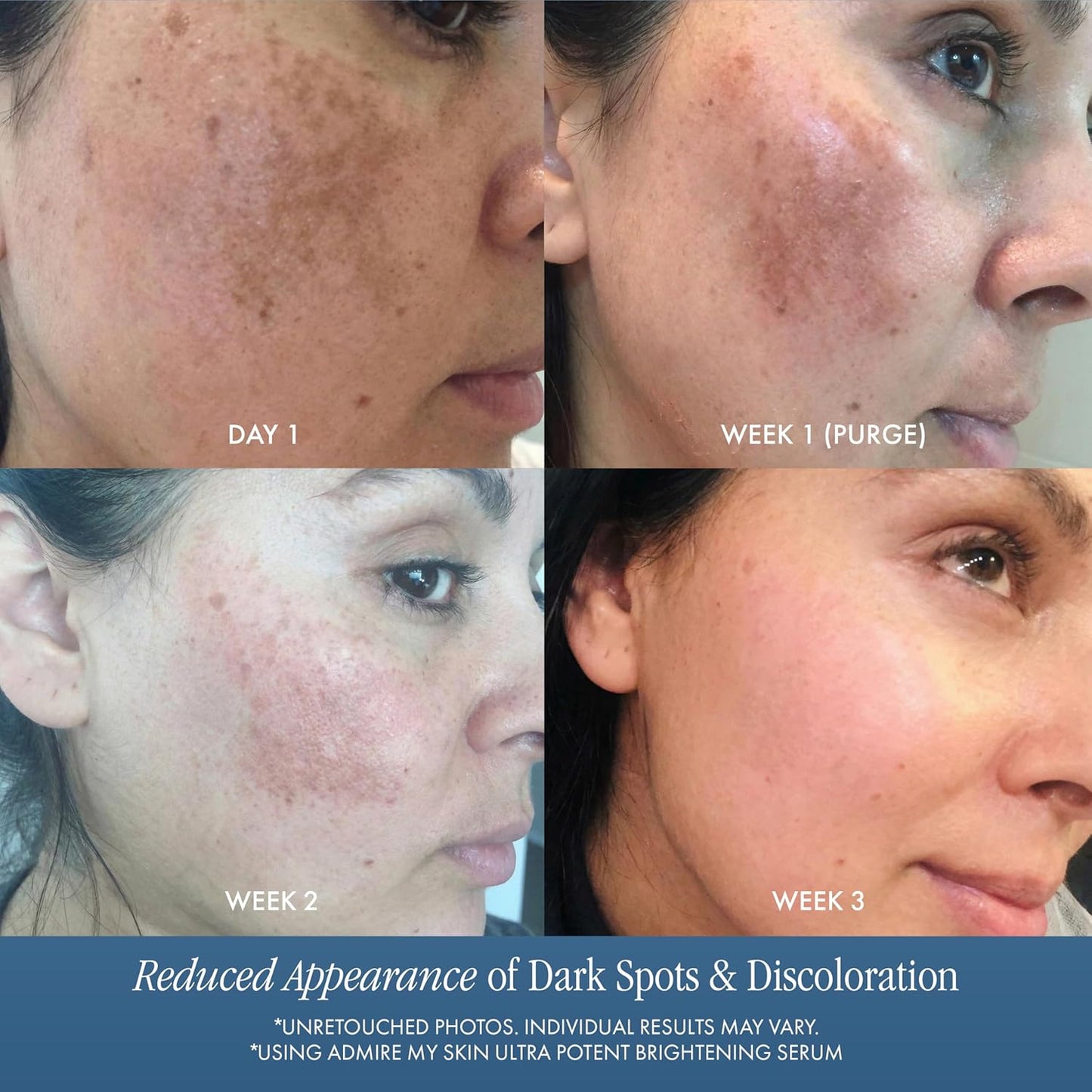 Admire My Skin Dark Spot Corrector Serum - Brightening Kojic & Azelaic Acid Formula | 1oz