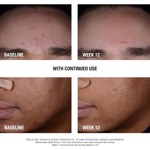 Neutrogena Acne Facial Serum - Oil-Free Formula with Salicylic & Glycolic Acids | 1 fl. oz for Clear Skin