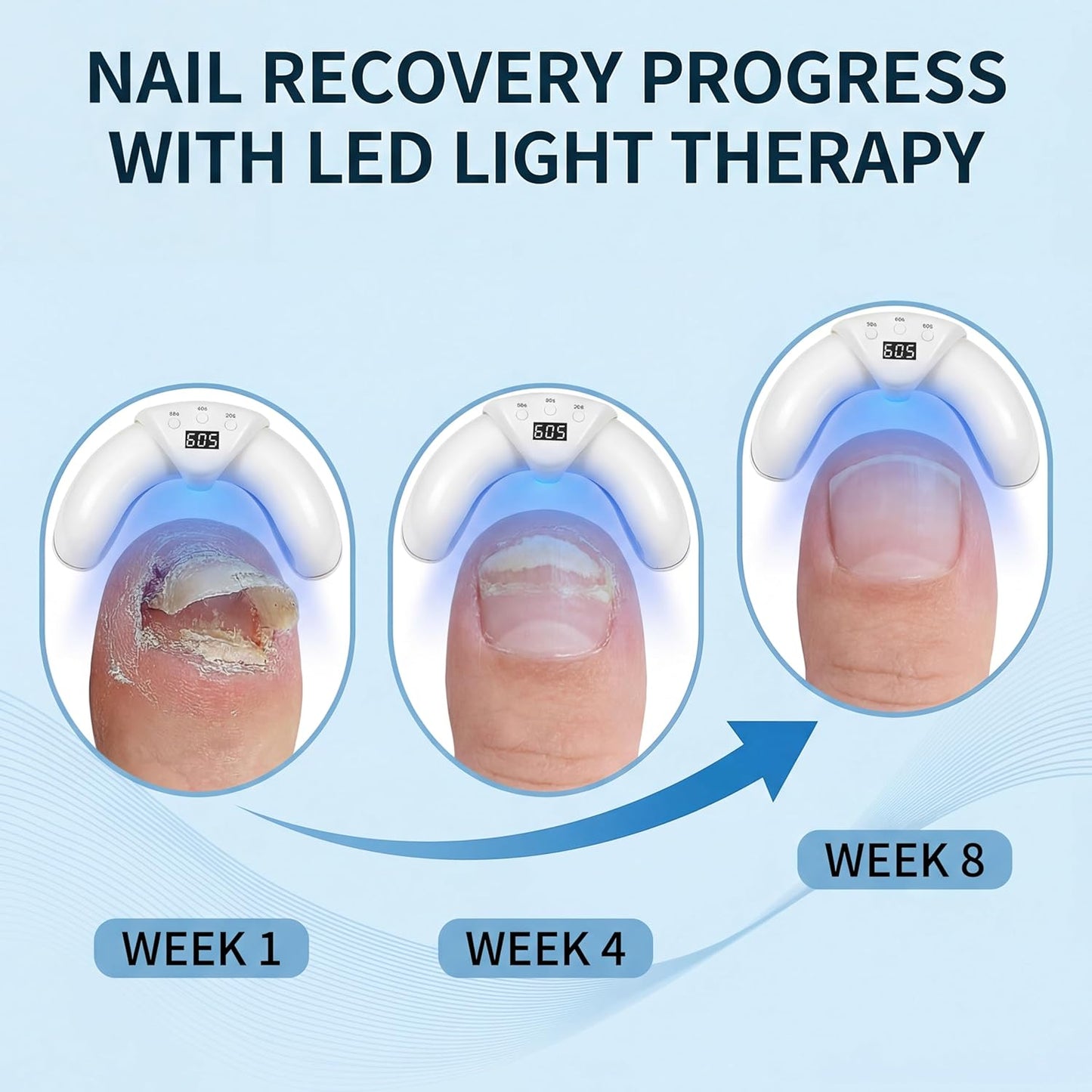 Skiennix 5-Finger Nail Fungus Treatment Device - Rechargeable LED Tool for Fingernails & Toenails