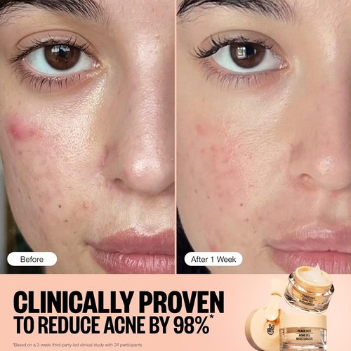 Peace Out Acne Gel Moisturizer - 2% Salicylic Acid & Niacinamide for Oily Skin | 1.69 fl oz