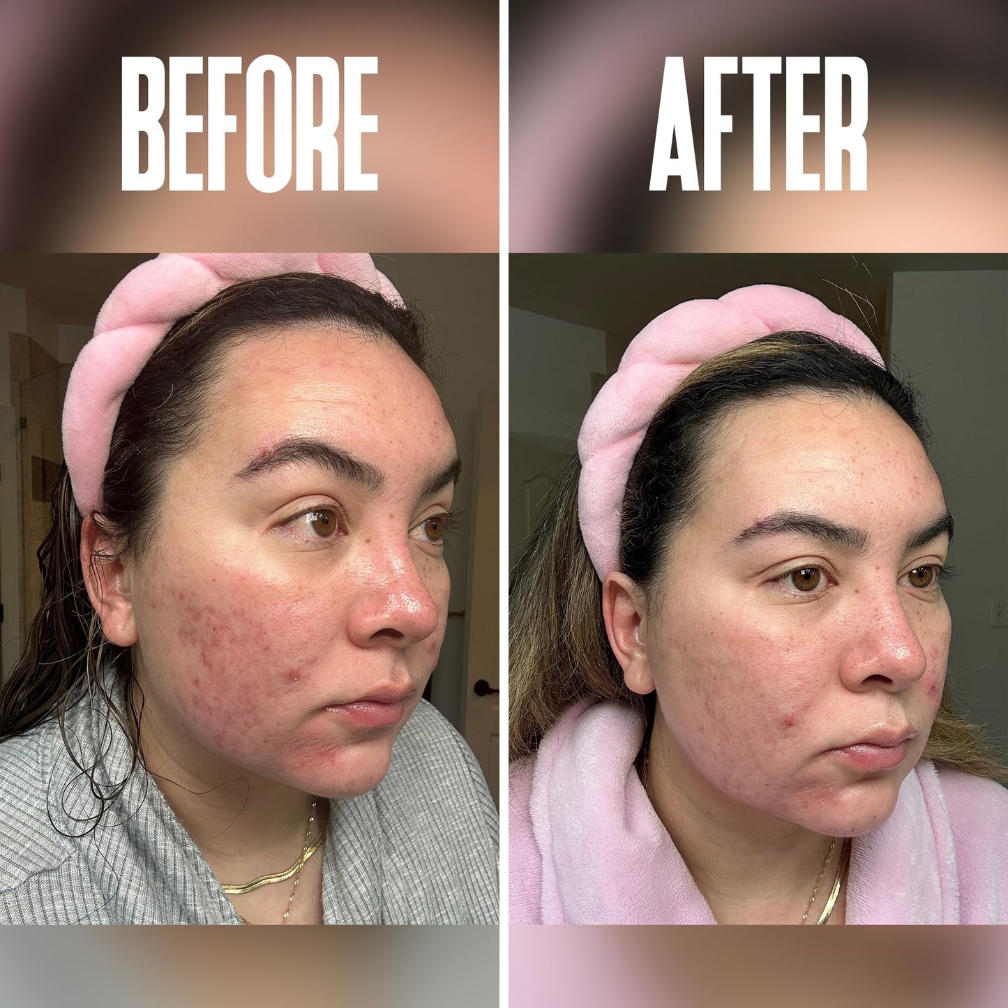 Glycolic Acid Pads with Vitamin C - Toner Pads for Face Cleansing With Tea Tree Oil - Exfoliating Pads with 20% AHA & Vitamins E, B3, B5 - Facial Peel Resurfacing Pads, Glycolic Acid Peel (50)