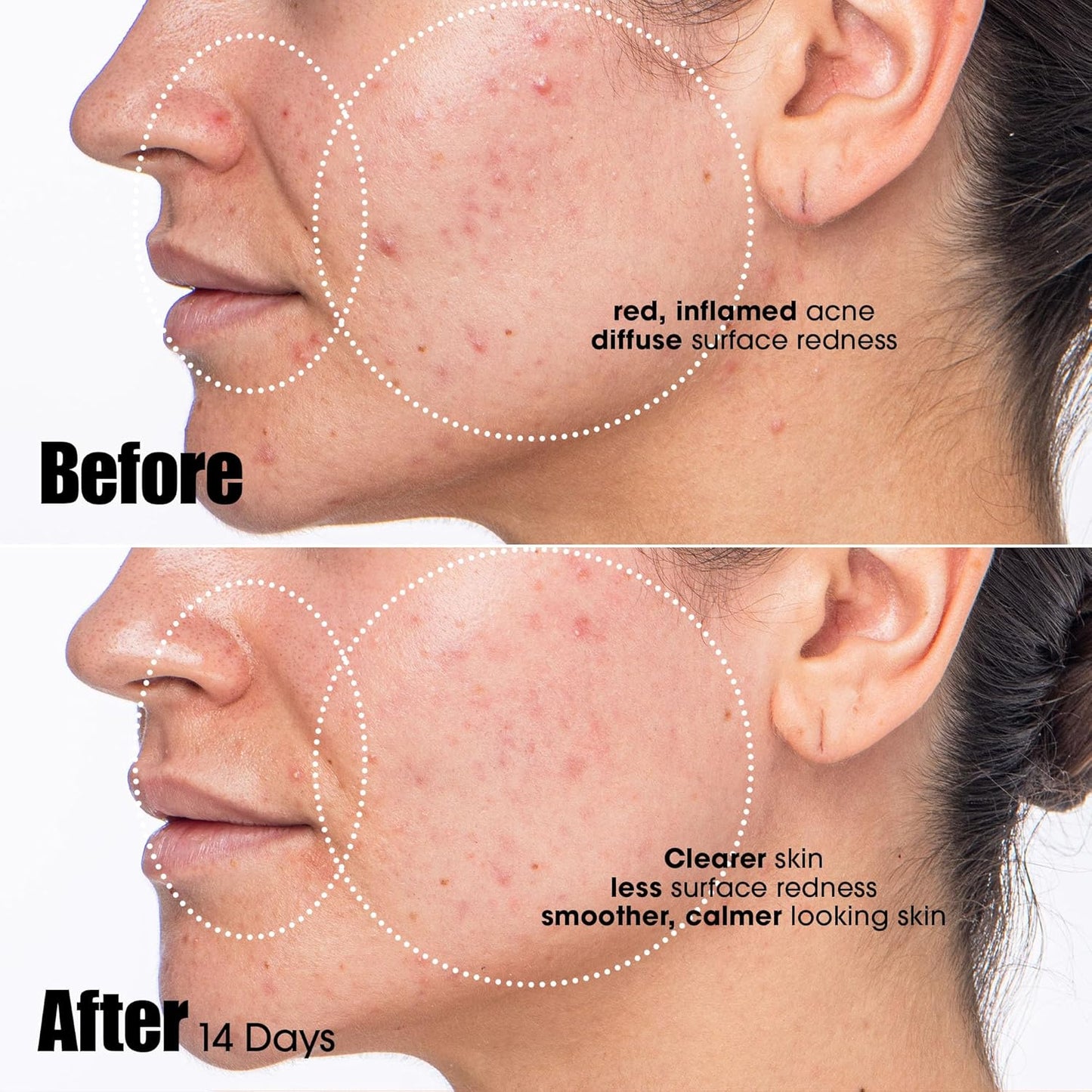 Sunday Riley Acne Treatment Serum - Azelaic & Salicylic Acid for Clear Skin