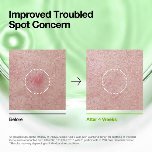 Anua Azelaic Acid 3 CICA Skin Clarifying Toner, Soothing & Clear Care, with Salicylic & Azelaic Acid, Sebum & Spot Care, Suitable for Sensitive Skin, Korean Skincare, 8.45 fl.oz