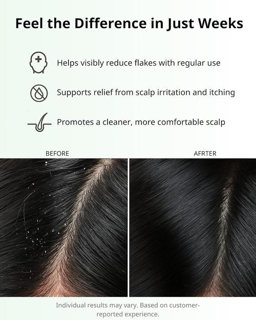 Regine Switzerland Anti Dandruff Shampoo - Sulfate-Free Scalp Care for Flaky, Itchy Scalp | 1% Zinc Pyrithione