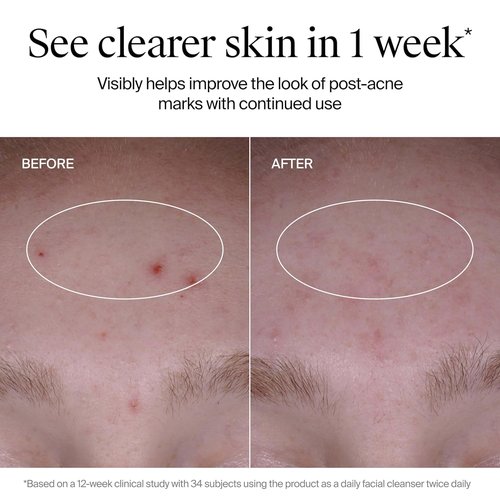 Neutrogena Evenly Clear Acne Cleanser - Gentle Foaming Face Wash with 2% Salicylic Acid & PHA | 9.1 fl. oz