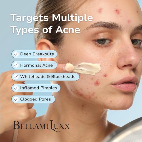 Cystic Acne Treatment for Face: Hormonal Acne Treatment Cream for Teens & Adults - Salicylic Acid & Tea Tree Oil Pimple Spot Remover - Anti-Acne Moisturizer Reduces Redness, Blemishes