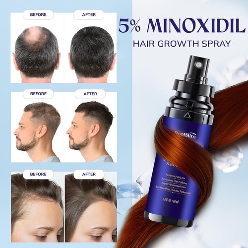 Minoxidil 5% Hair Growth Serum - Extra Strength Treatment for Men & Women | 2-Pack, 60ML Each