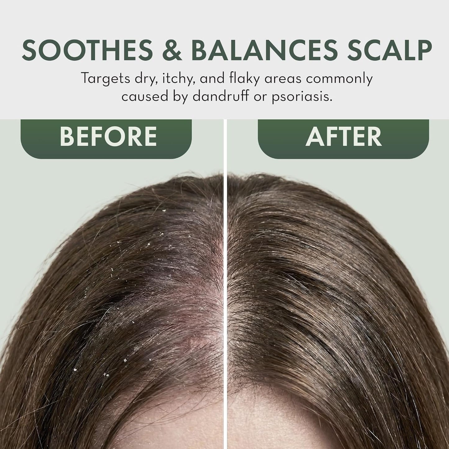 Skiennix Leave-In Conditioner Spray | Tea Tree Scalp Treatment for Dandruff Relief - Hydrating Formula for Itchy Scalp & Psoriasis Care