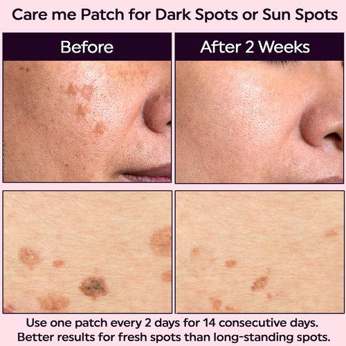 Care Me Microdart Dark Spot Patch - 127 Micropoints for Fading Acne Marks & Dark Spots | 1 Pack of 9 Patches