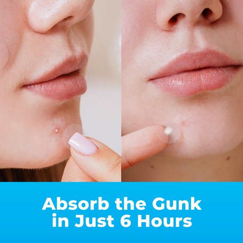 PatchRx Pimple Patches for Face (120 Patches), Hydrocolloid Acne Patches with Tea Tree Oil, Pimple Patch Pimple Stickers - Hydrocolloid Patch Acne Dots - Acne Pimple Patches For Face - Zit Patches