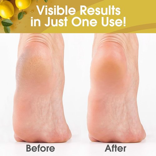 DeEnti Callus Remover Gel - Extra Strength 8oz for Dry Skin & Cracked Heels | Professional Pedicure Care