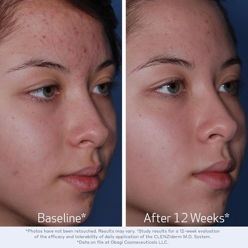 Obagi CLENZIderm M.D. Acne Cleanser - Daily Foaming Treatment with 2% Salicylic Acid (BHA)