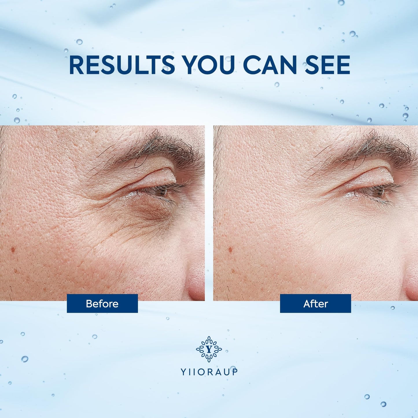 Eye Bags Treatment for Men: Eye Roller for Puffy Eyes and Under Eye Puffiness Reducer – Caffeine Eye Cream for Dark Circles and Wrinkles