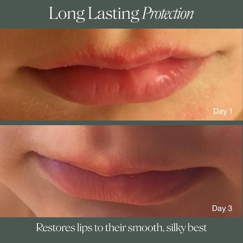 Doctor Rogers Lip Balm - Hydrating & Softening Moisturizer for Very Dry Lips | Natural & Hypoallergenic, 0.15 Ounce (Pack of 3)