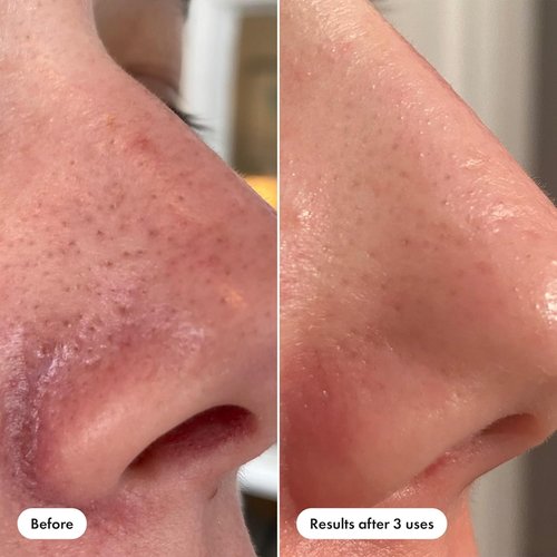 Hero Cosmetics Pore Release Blackhead Clearing Solution - Exfoliating 2% Salicylic Acid Toner, 100 ml