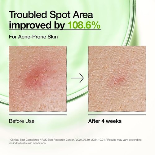 Anua Azelaic Acid 10% Serum - Redness Soothing Facial Serum for Blemish-Prone Skin | 1.01 fl oz