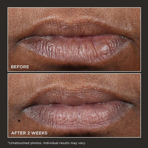Perricone MD Lip Therapy - Cold Plasma Plus+ Formula for Youthful Hydration
