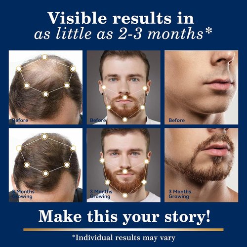 Regine Switzerland 5% Minoxidil Hair Growth Spray Kit - Extra Strength Treatment for Thinning Hair & Beard - 2PCS