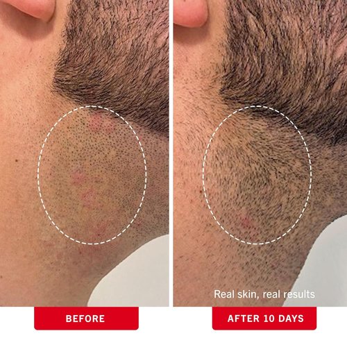 First Aid Beauty - Ingrown Hair Treatment Pads with BHA & AHA - Prevent Razor Bumps & Exfoliate - 60 Compostable Pads