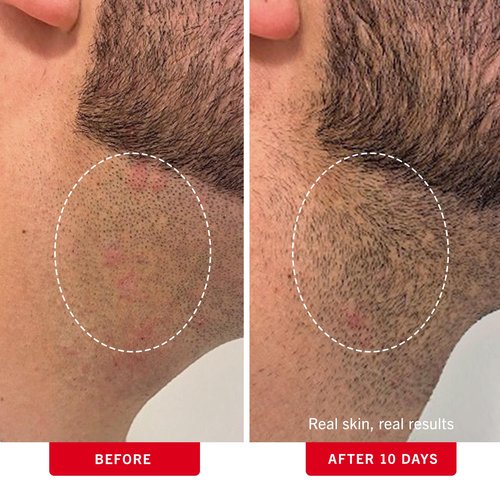 First Aid Beauty - Ingrown Hair Pads