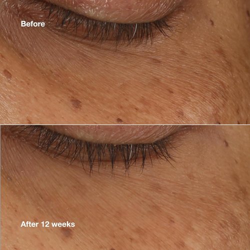 Clinique All About Eyes Brightening Serum - Vitamin C, Hyaluronic Acid & Retinol | Hydrating, Reduces Dark Circles, 0.34 Fl Oz
