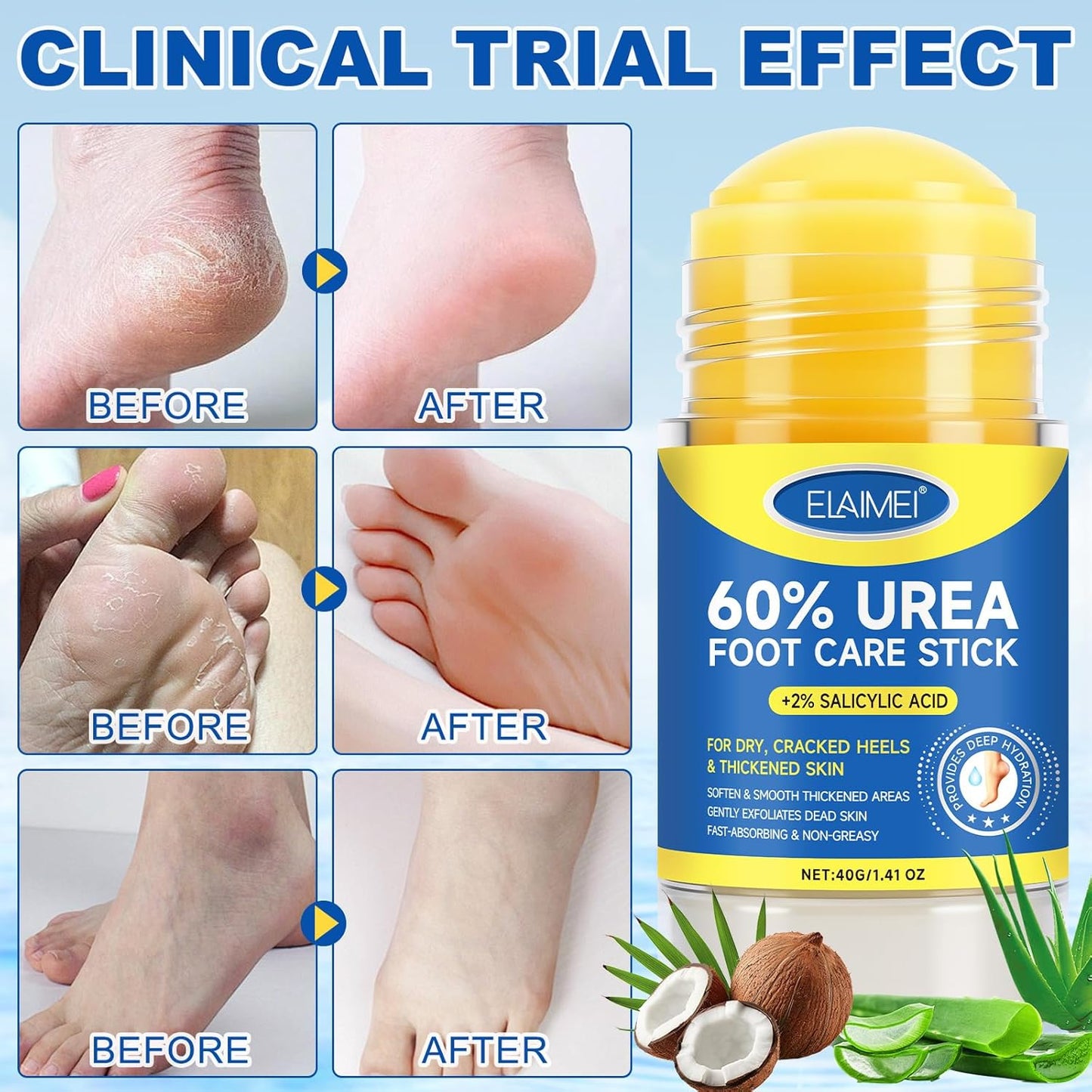 Urea Cream Stick 60% | Extra Strength Urea Foot Cream with 2% Salicylic Acid for Dry Cracked Heels