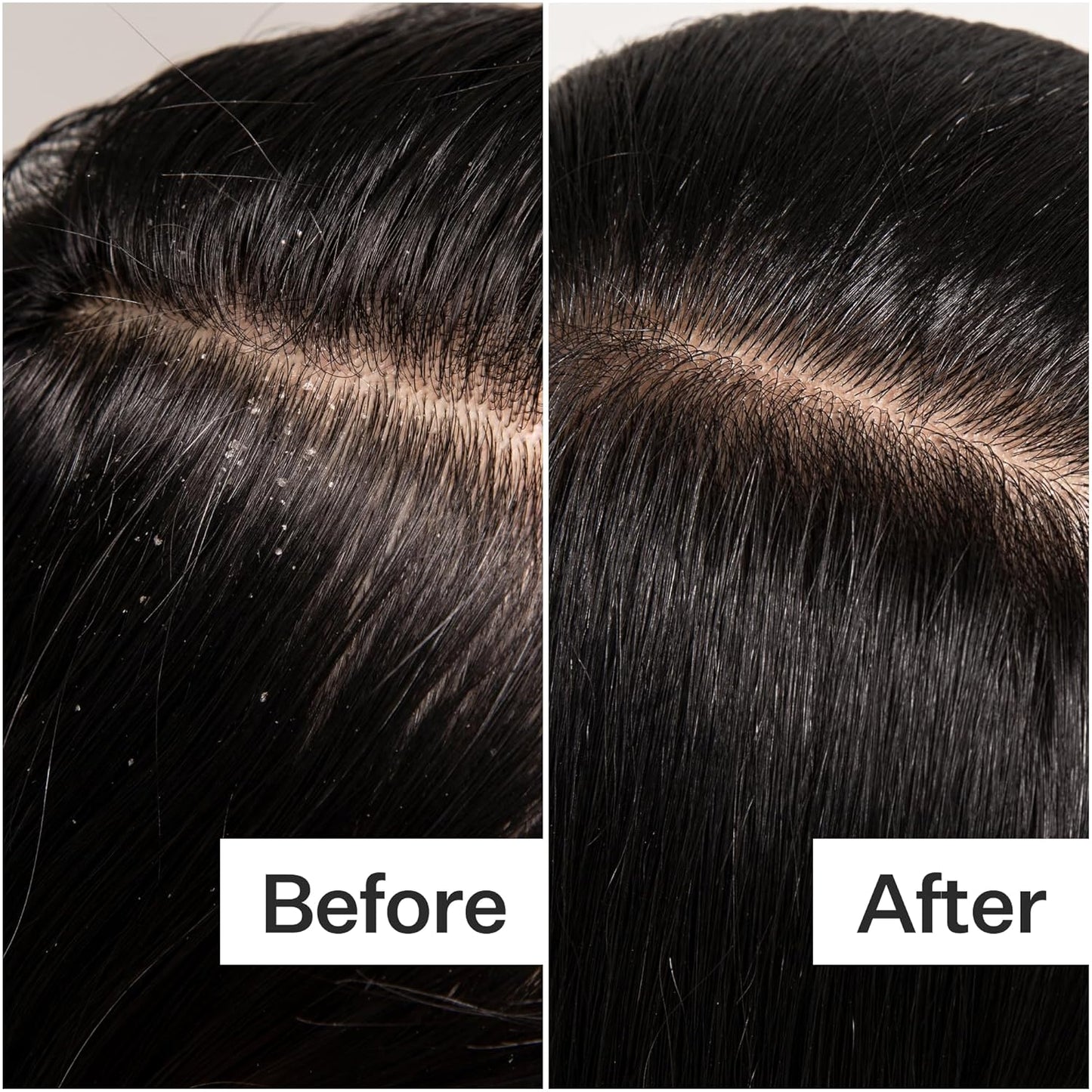 ACT+ ACRE Cold Processed Scalp Detox Oil - Sulfate-Free Treatment for Flaky, Dry Scalp - Promotes Thicker Hair