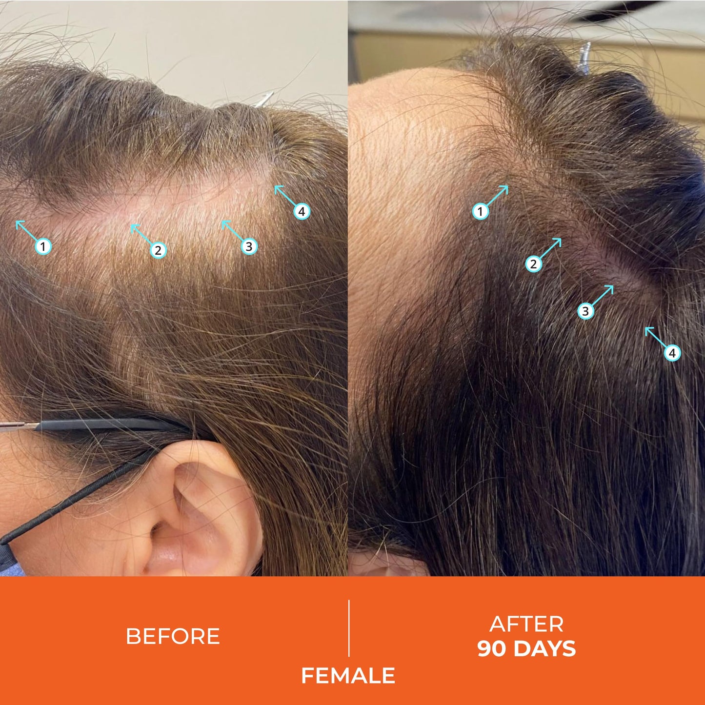 DS Laboratories Revita Shampoo and Conditioner Set - Hair Density Shampoo and Conditioner, Strengthening, Thickening, for Fine Hair, DHT Blocker for Women & Men, 205mL