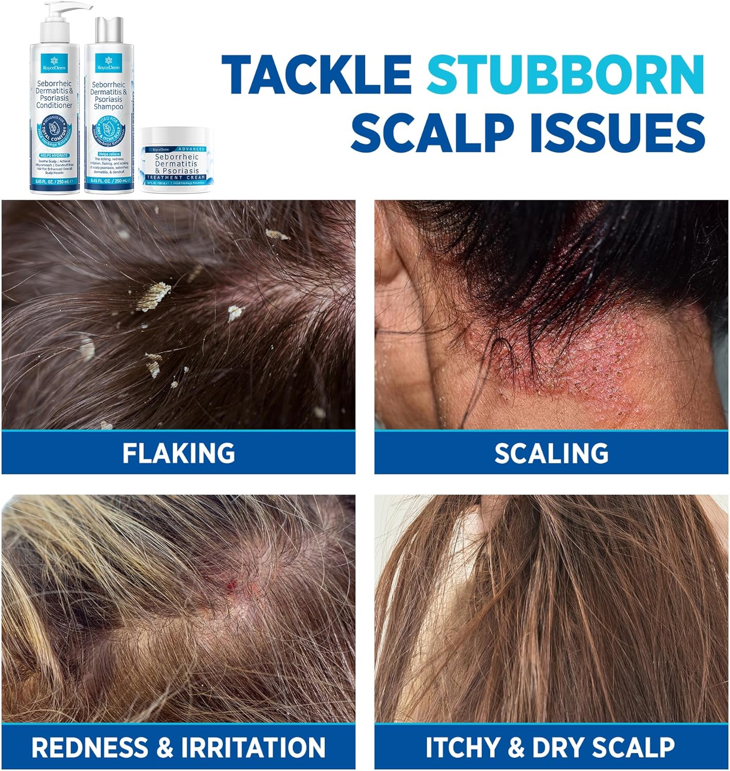 Seborrheic Dermatitis & Psoriasis Cream by [Brand Name] - Scalp Therapy Set for Itching Relief & Flaking Control