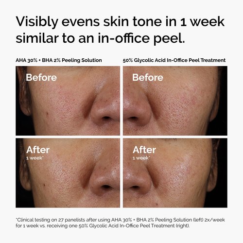 The Ordinary AHA 30% + BHA 2% Peeling Solution, Advanced Exfoliating Peel for Brighter Skin, 1 Fl Oz