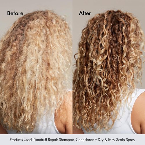 BONDIBOOST Anti-Dandruff Shampoo - Soothe Itchy Scalp & Revitalize Hair | Long-Lasting Relief
