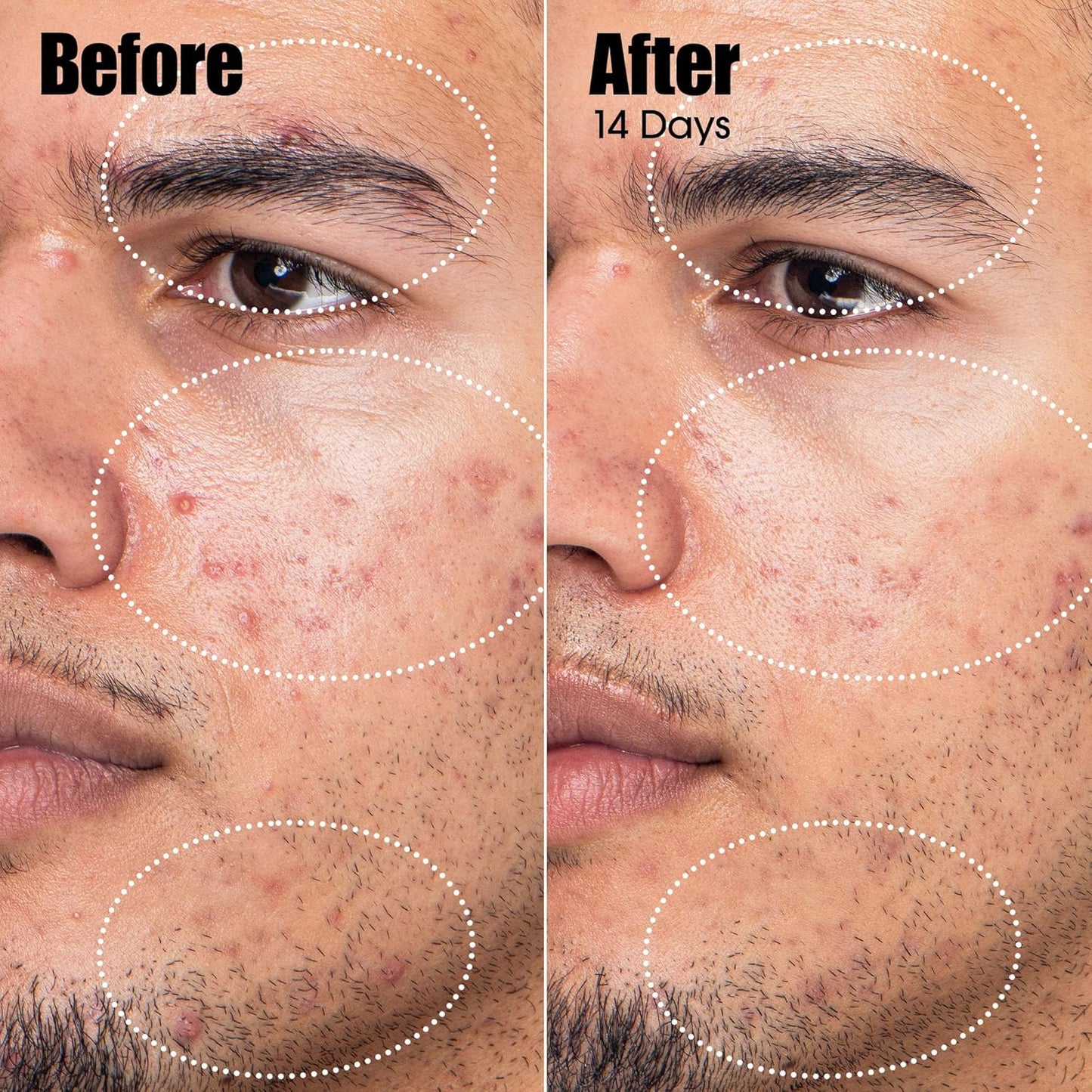 Sunday Riley Acne Treatment Serum - Azelaic & Salicylic Acid for Clear Skin