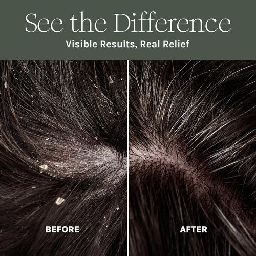 Purist Dandruff Spray – Leave-In Itchy, Dry Scalp Treatment – Hydrating, Lightweight, Soothing Scalp Moisturizer – Scalp Care Spray for Dryness, Dandruff, Flaky Scalp – Non-Greasy and Quick Relief