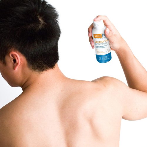 Acne Free Salicylic Acid Body Spray - Exfoliate & Unclog Pores | 5 Ounce (Pack of 3)