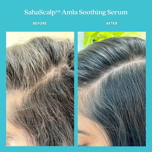 Fable & Mane Amla Soothing Serum - Detox Treatment with Rosemary Oil for Dry, Itchy Scalps