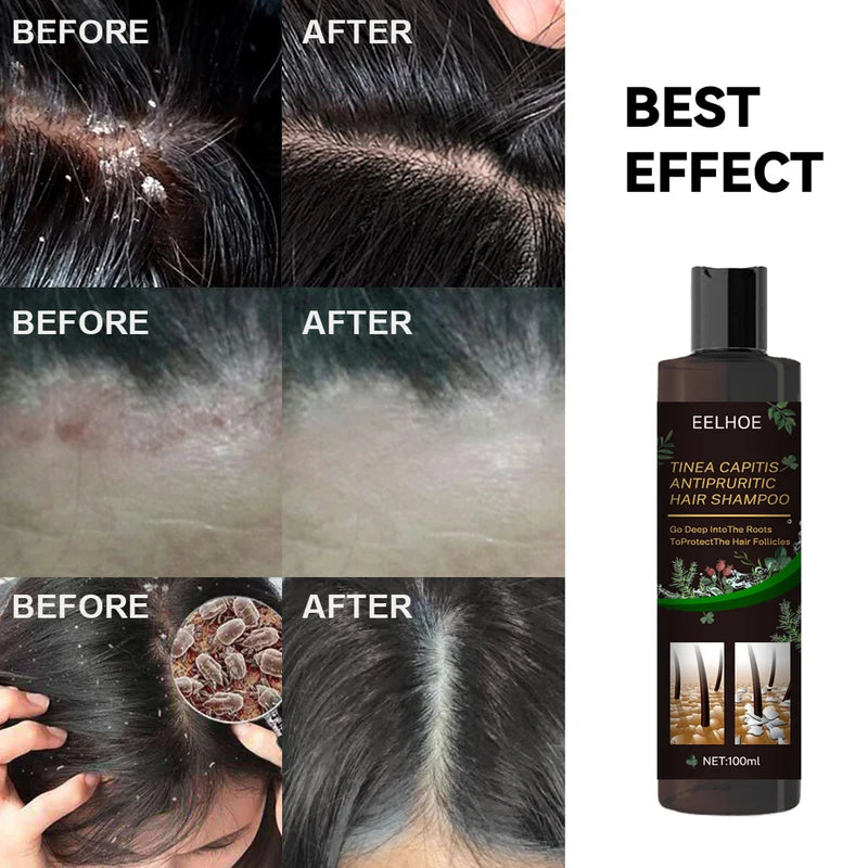 Anti Dandruff Hair Shampoo with Scalp Care & Oil Control - 100ml