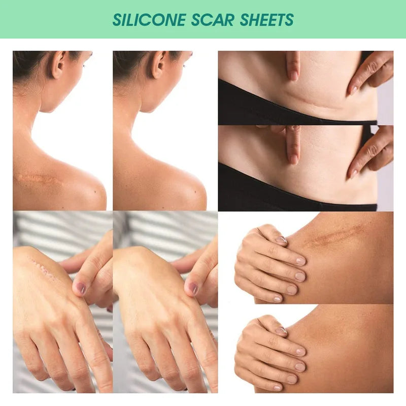 Scar Patches Silicone Gel Sheet Correctors for Skin Repair Self-Adhesive Burn & Wound Cover