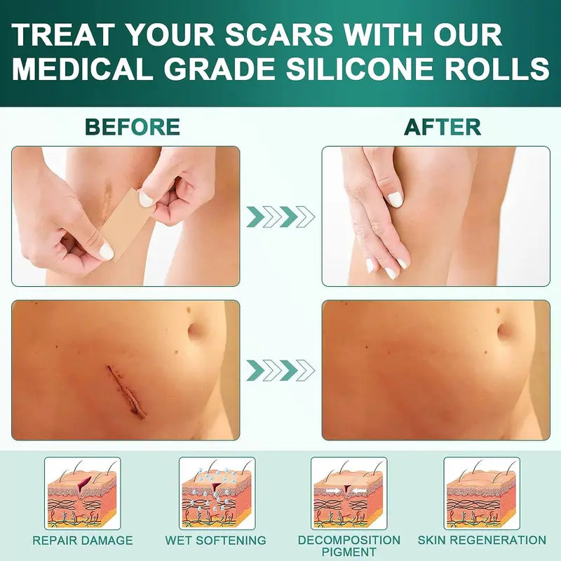 Silicone Scar Treatment Sheets Roll Reusable Strips for Keloid & Burn Scars