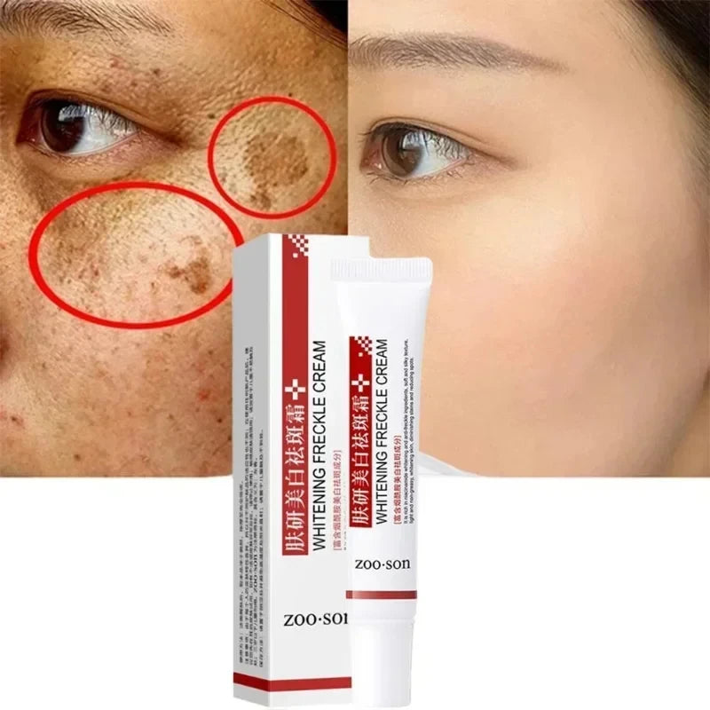 Whitening Freckle Cream for Dark Spot Removal & Brightening - 20g