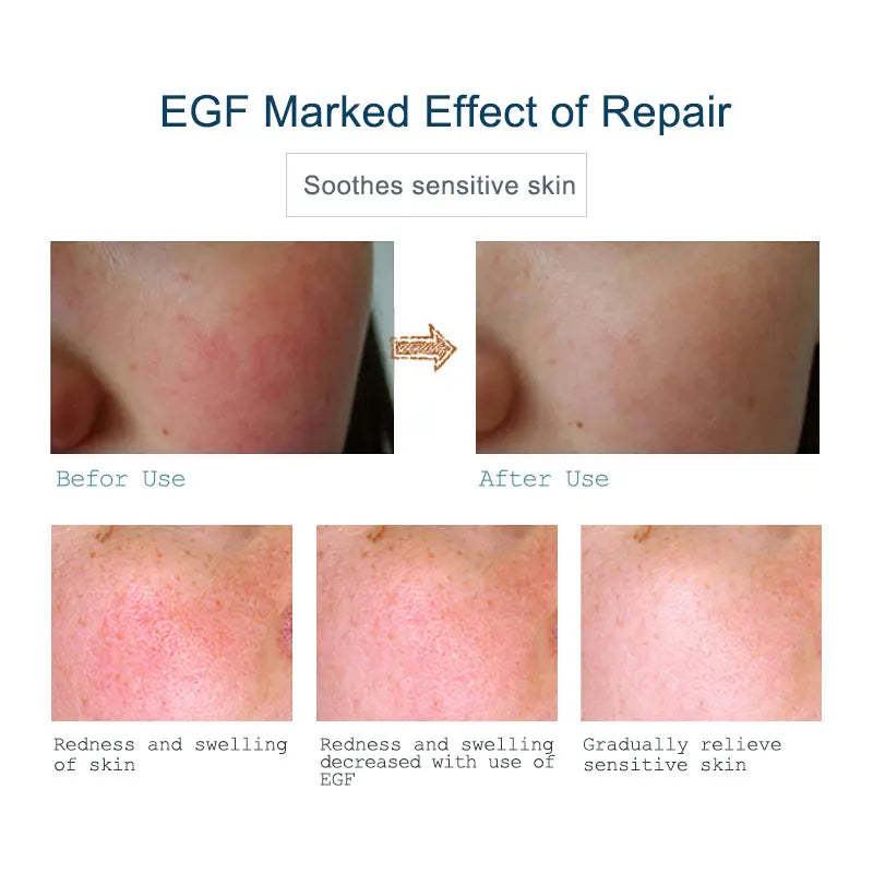 EGF Face Serum for Moisturizing Oil Control & Blackhead Removal - 3PCS
