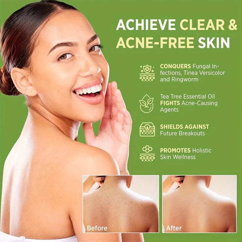 Gentle Anti-Fungal Tea Tree Oil Soap for Sensitive Skin - Moisturizing Acne Care