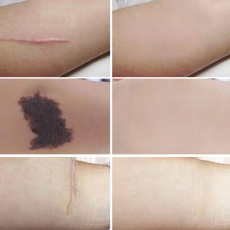 6 Pcs Waterproof Tattoo Concealing Patches Ultra Thin Skin-Colored Tape