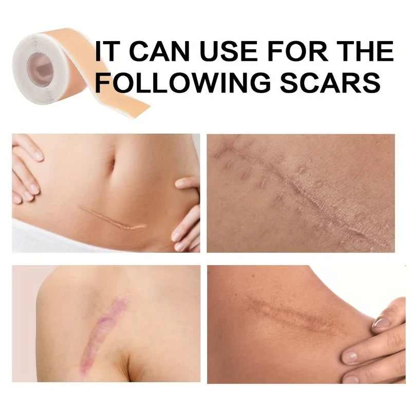 Invisible Silicone Scar Cover Patch Skin Care Covering 150cm - Multiple Colors