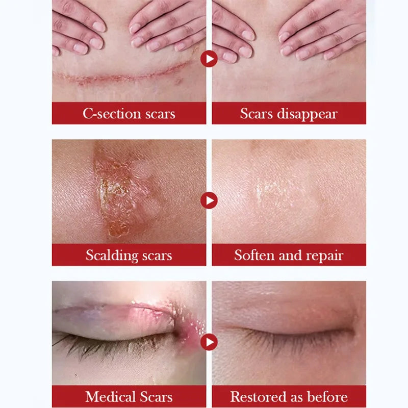 Scar Repair Cream for Skin Wounds and Scars - Moisturizing Rejuvenating Gel