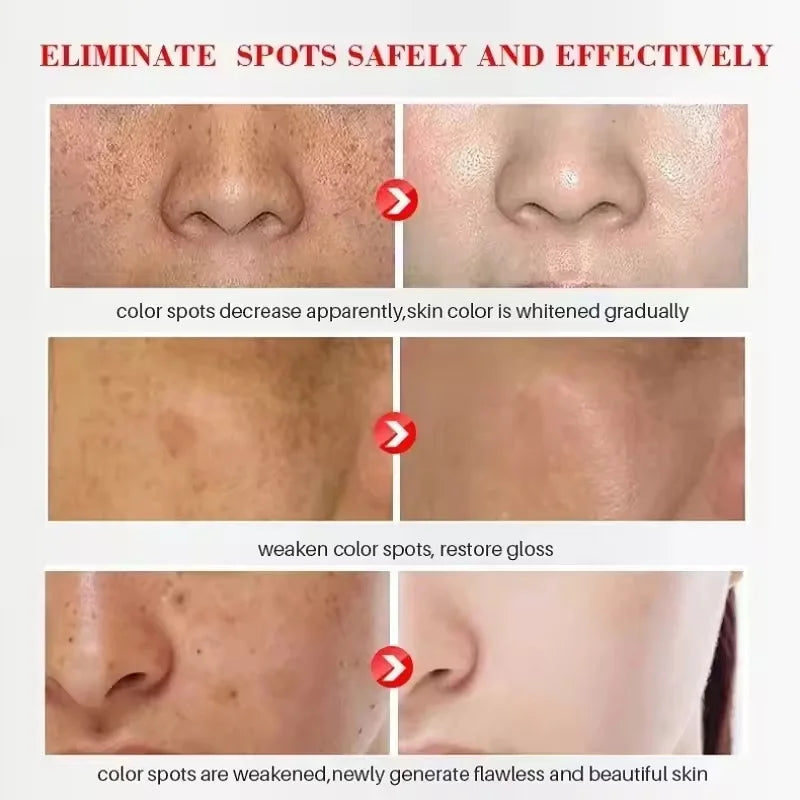 Freckle Whitening Cream for Dark Spots Melasma Skin Brightening & Hydration