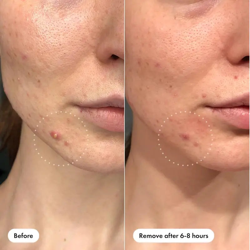 Hydrogel Acne Patches - 400 Sheets Facial Blemish Spot Treatment for Light Skin